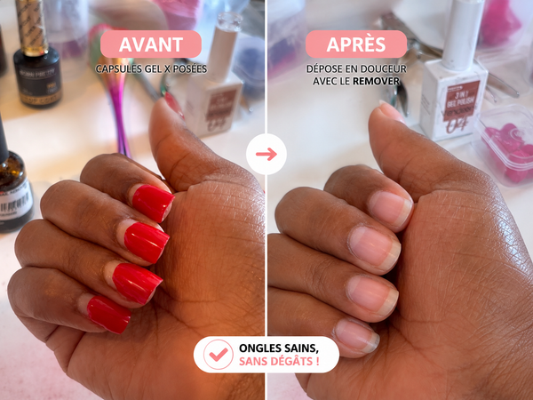 avant- apres dépose 